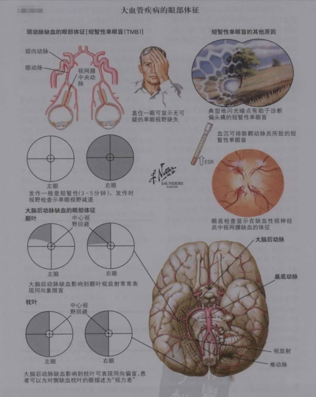 颈动脉来源的tmb患者当正常眼被遮住时不能看见,因为在缺血时阻塞的