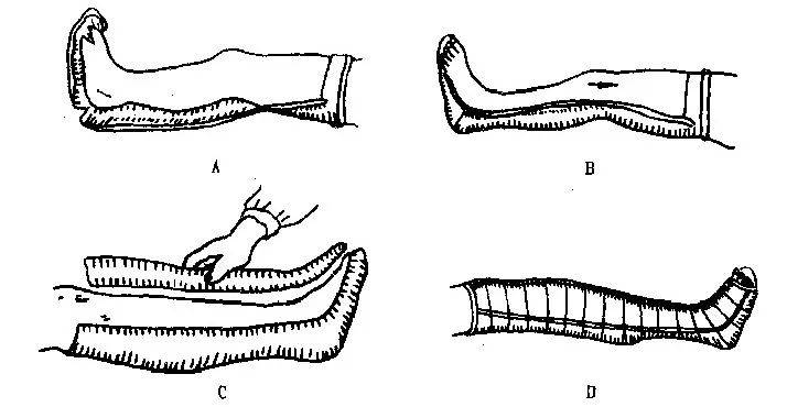 石膏托:将石膏绷带折叠成石膏条,置于伤肢的背侧或后侧.