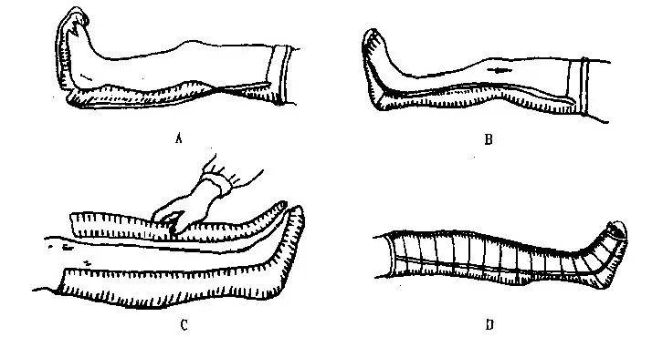 厚度:上肢:10～12层 下肢:12～15层  石膏管型:指将石膏条带置于伤肢