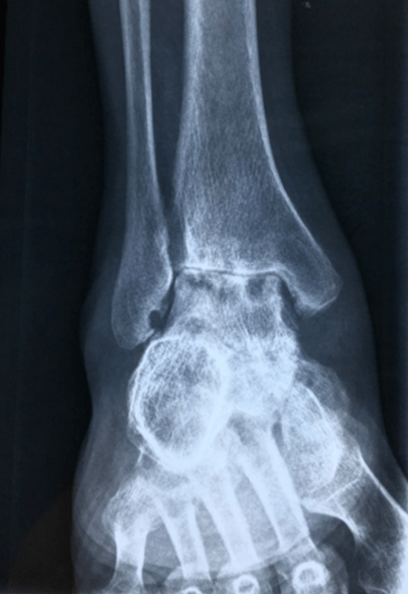 2015年2月6日右踝关节x光片 害,本以为放下了心头大石,没想到半年后