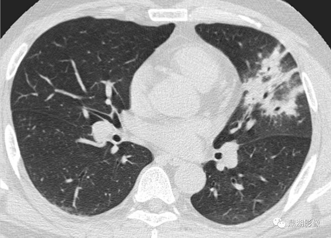 军团菌肺炎的影像表现(legionella pneumonia)_手机搜狐网