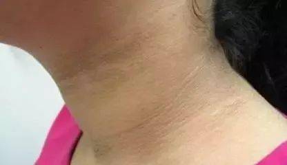 脖子上出现这个东西,是糖尿病的表现!赶快重视起来!