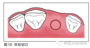 翻瓣术切开步骤切开step1牙槽嵴顶切口,以执笔式持手术刀,切开前须找