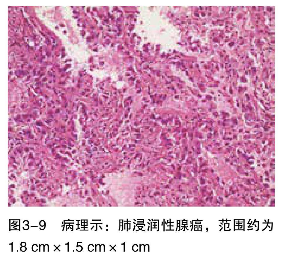 今天走进浸润性腺癌主题课堂一起学习相关病例肺结节交互印证式诊断