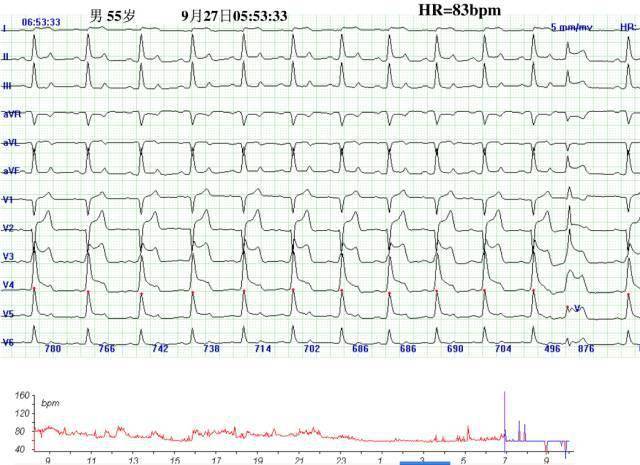 八大病例:教你看懂心肌缺血发作时的心电图表现