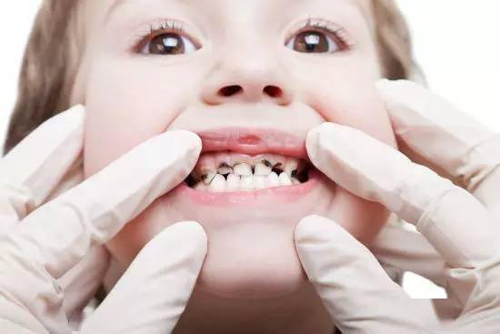 儿童牙病无痛微创治疗主要是治疗哪些牙齿疾病,有何特点和优势?
