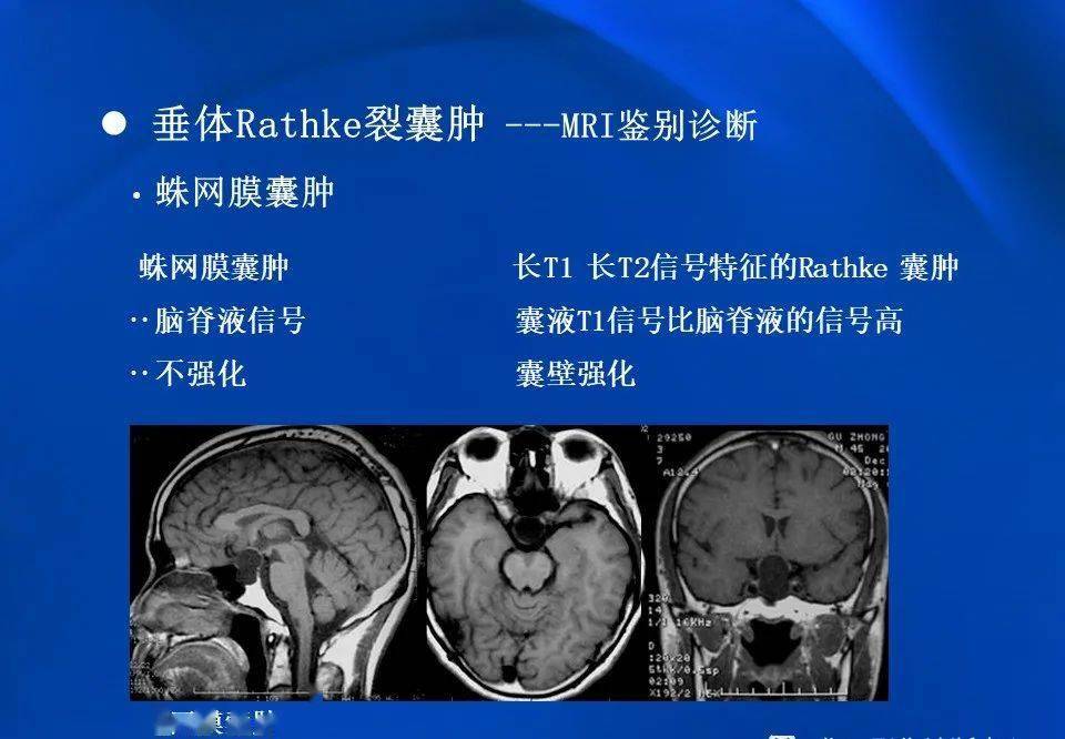 影像拉克氏囊肿的mri表现及鉴别诊断