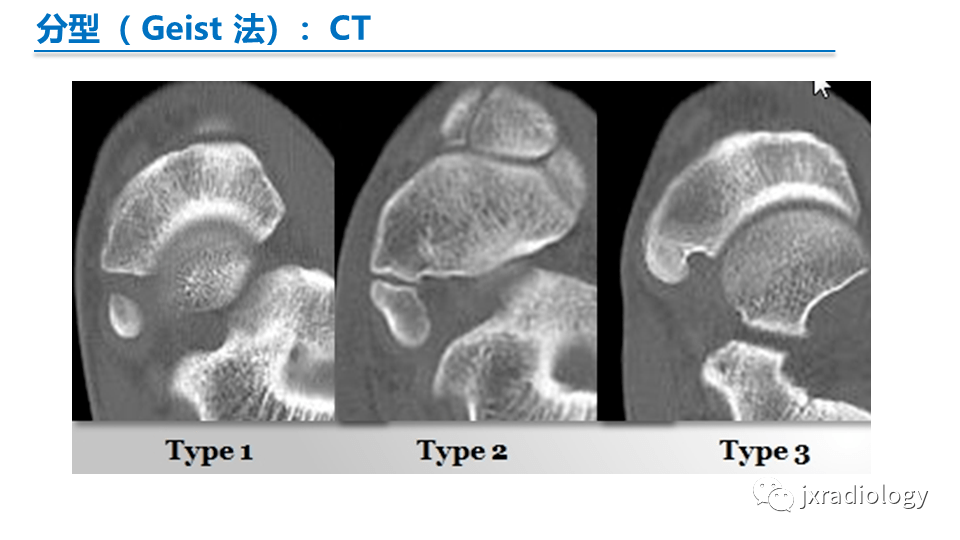 足副舟骨分型及相关病变