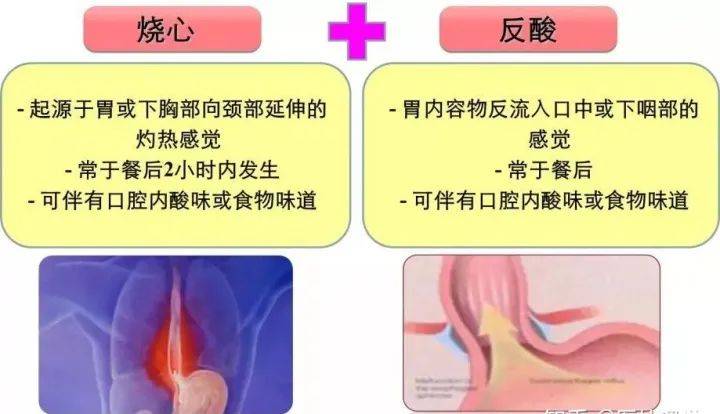 症状1:酸液逆流 病人会呕酸水,或感觉喉咙有液体跑上来,有些夜晚型