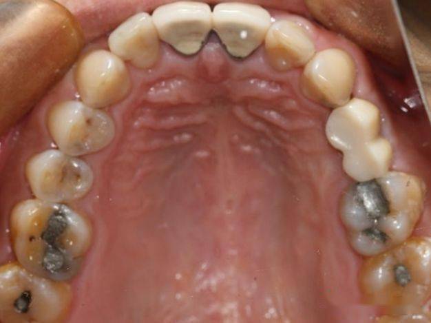 【病例分享】下颌后牙区种植同期角化粘膜移植一例