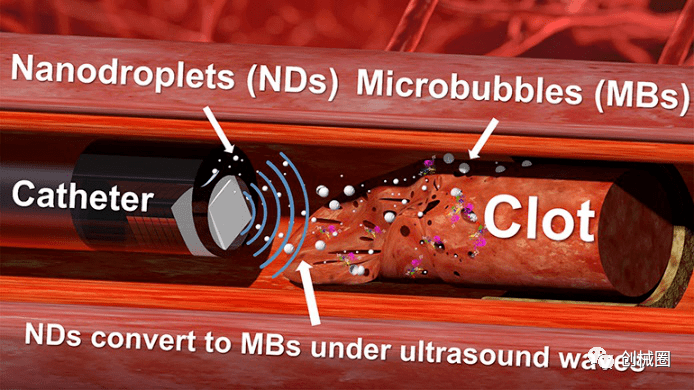新技术纳米液滴和超声波可穿透血栓