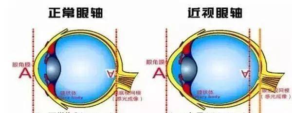 正常眼球和近视眼球对比图