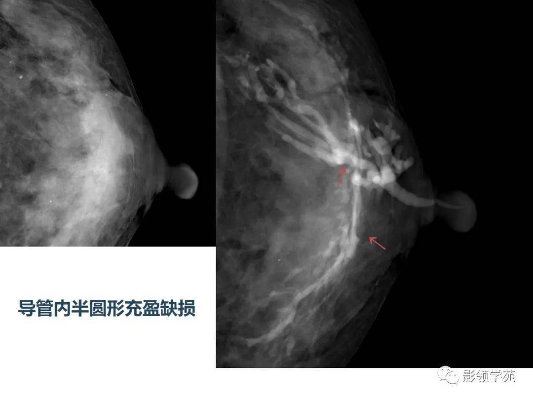乳腺常见良性肿瘤及肿瘤样病变影像诊断_导管