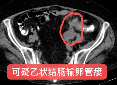 成功抢救乙状结肠憩室炎穿孔子宫致感染性休克病人_患者