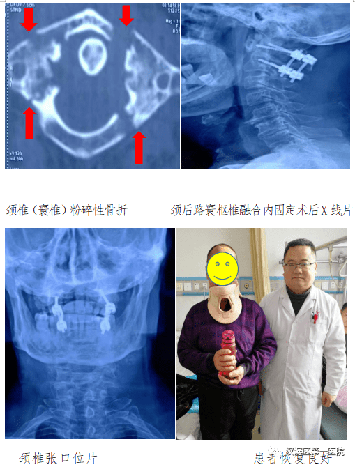 经科室专家充分讨论分析后,决定对患者实施寰枢椎融合内固定术,该手术