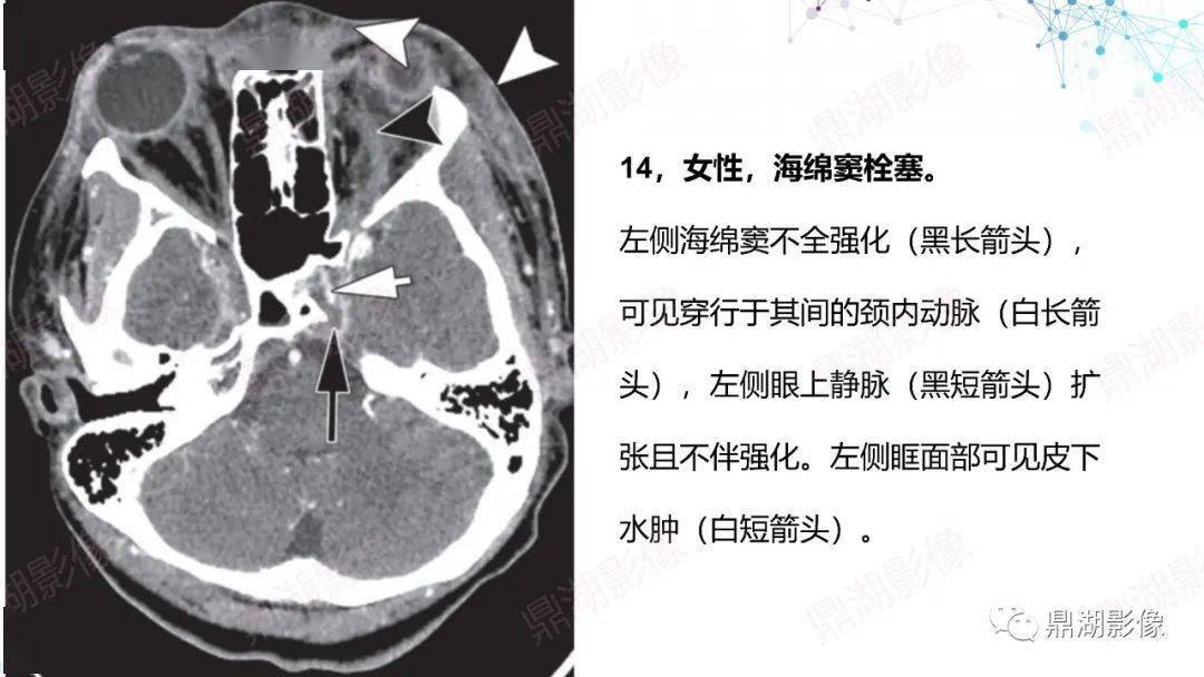 图解颈部ct影像阅片及诊断报告要点