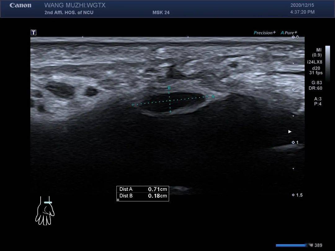 典型超声病例:腕管综合征的超声诊断思路