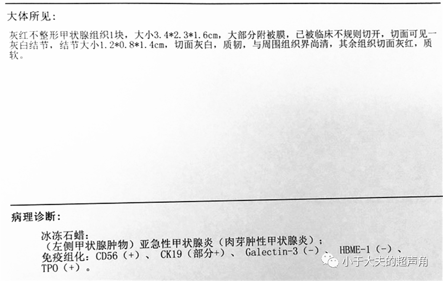 【超声随响】第47期 亚急性甲状腺炎 肉芽肿性甲状腺炎