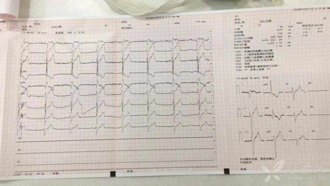 心梗患者,术中心电图多变 | 达摩心电图专栏