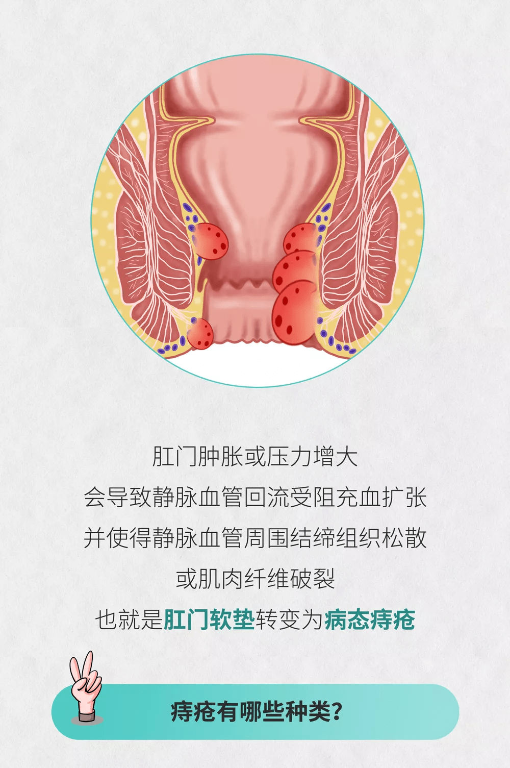 医学图说|十男九痔,你真的了解痔疮吗?