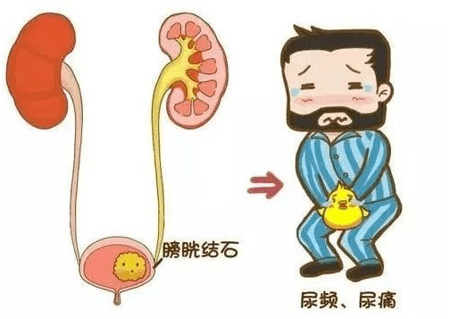 【健康984】有一种痛,叫泌尿系统结石.