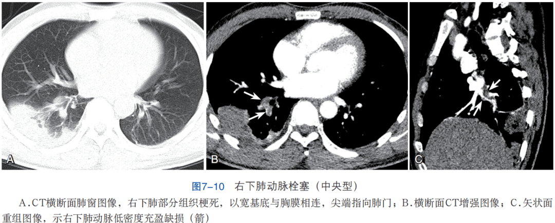 【干货】秒懂 ct血管成像检查和诊断要点:急性肺动脉栓塞