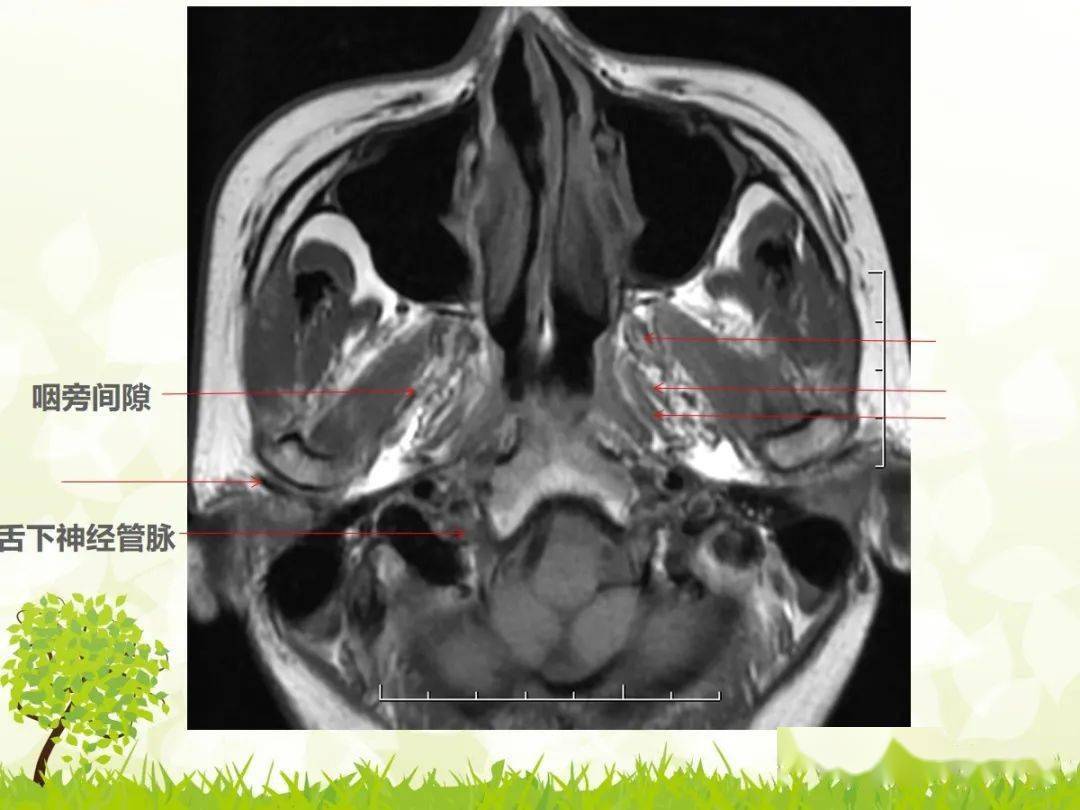 咽旁间隙解剖及常见病变影像表现