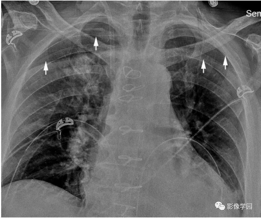 半卧位 胸部x线平片显示多条白色细线(白箭),类似气胸的白 色胸膜线