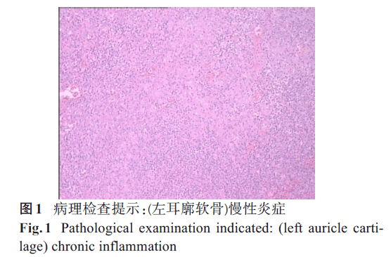 误诊为耳廓软骨膜炎的复发性多软骨炎1例