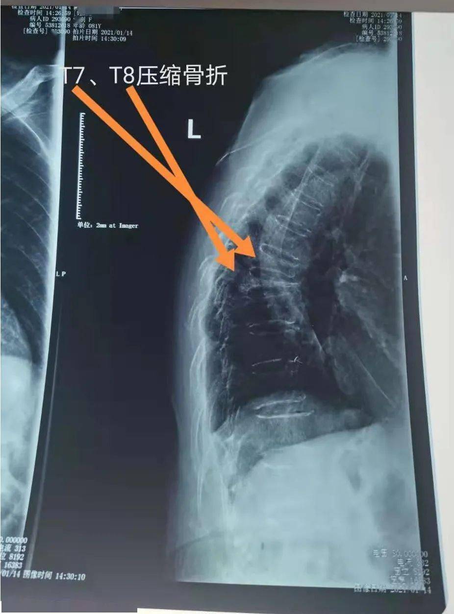 术前t7,t8椎体情况