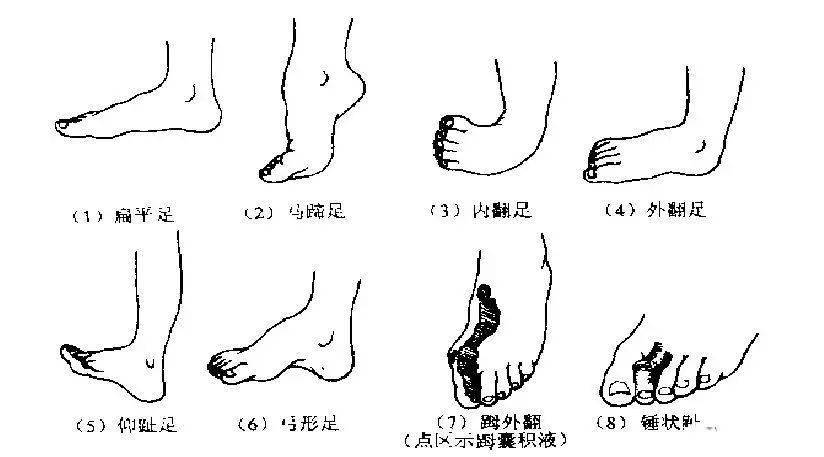 跟腱损伤检查