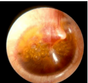 分泌性中耳炎图片