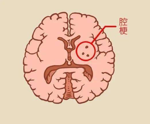 腔隙性脑梗塞有什么症状?
