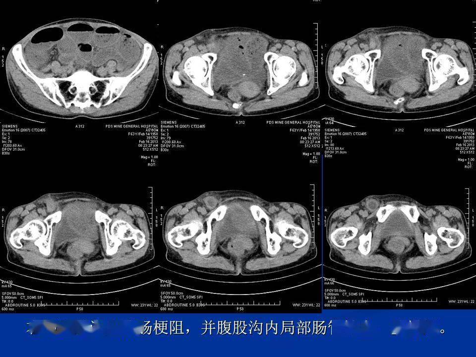 肠梗阻的分类及影像学表现(高清图片 文字讲解!_腹部