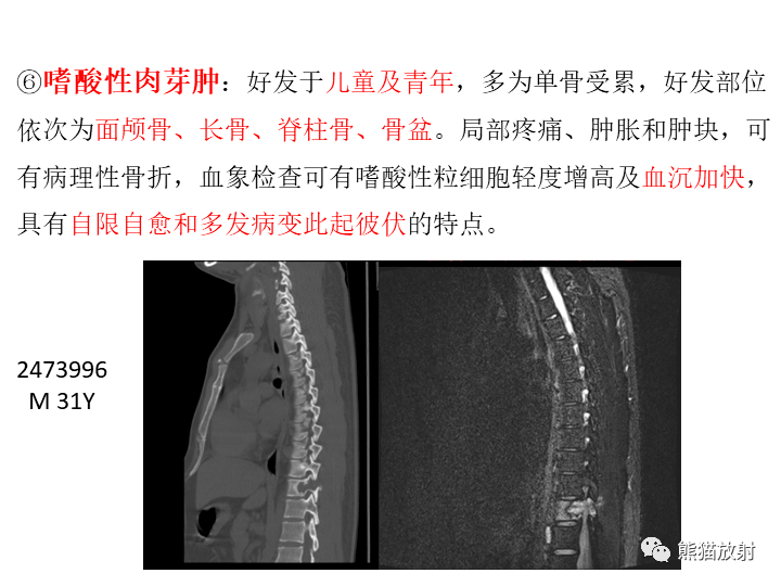 脊柱骨母细胞瘤 返回搜  
