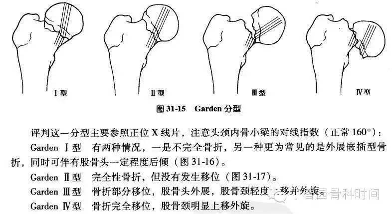 骨的完整性部分中断;Ⅱ型:完全骨折但不移位或嵌插移位,占股骨颈骨折