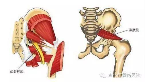 梨状肌综合征