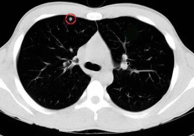 【知识点】肺部结节灶,看看影像科医生怎么处理