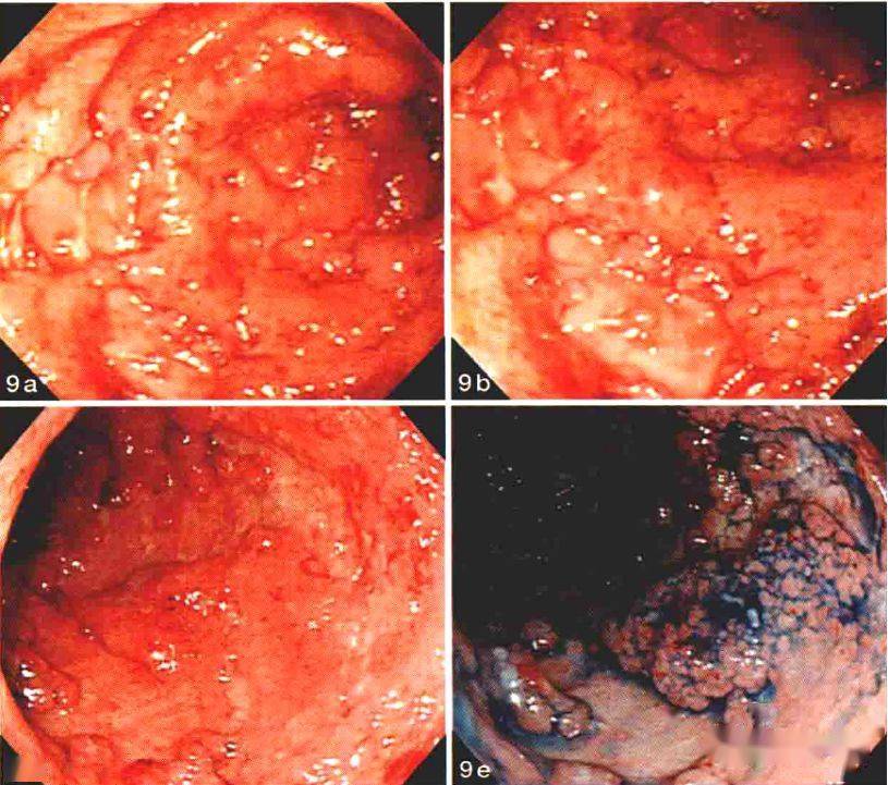 【结肠炎性息肉】35.【结肠腺瘤】36.【ssa/p 锯齿状腺瘤 tsa】37.