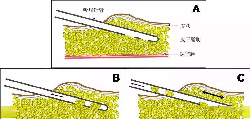吸脂管从皮肤切口插入进入皮下脂肪层; b.