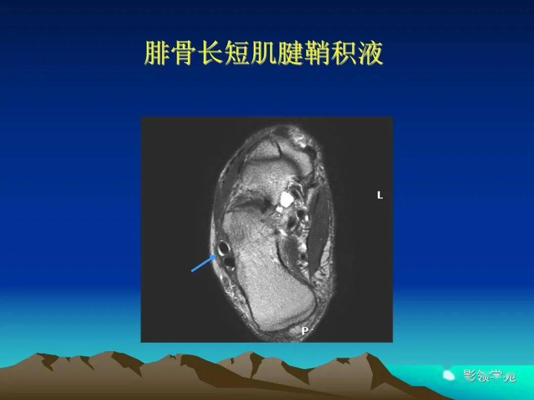 踝关节外侧韧带急性损伤的mri表现