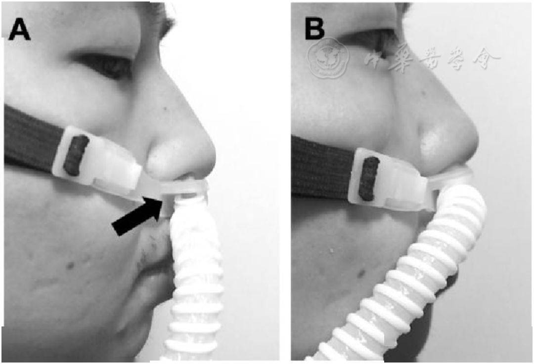 但hfnc与鼻塞连接不紧密会显著增加呼出气体的分散距离(流量60 l/min