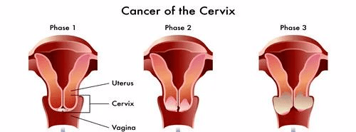 宫颈癌发出的第一个信号常常在月经紊乱有这3种表现的人最好去检查一