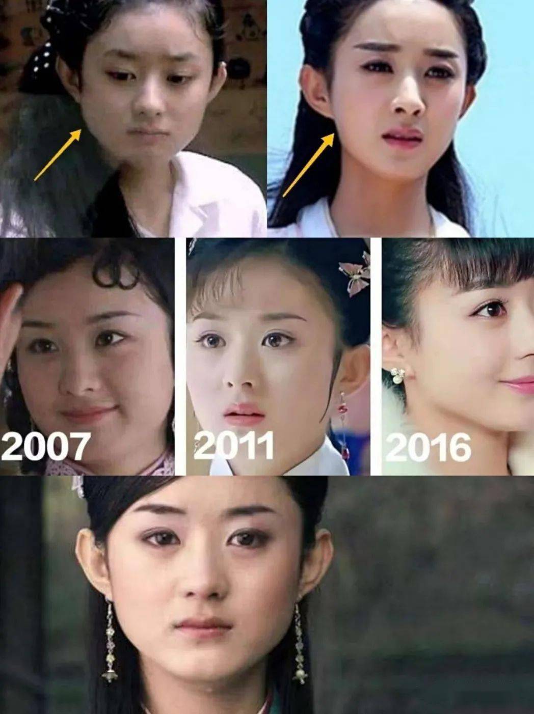 聊聊当红小花旦赵丽颖的变美之路打了瘦脸针面部吸脂