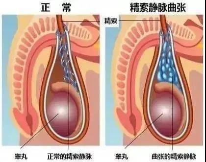 【新技术】精索静脉曲张 外一科腹腔镜手术解决"男"题_睾丸