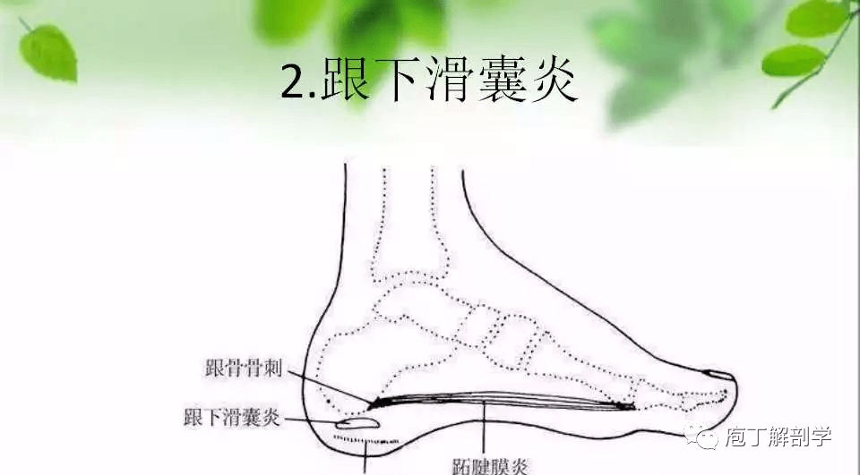 第二个病是跟下滑囊炎,跟下滑囊位于跟下脂肪垫与跟骨之间.