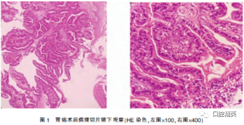 胃腺癌牙龈转移的病例报告及文献复习