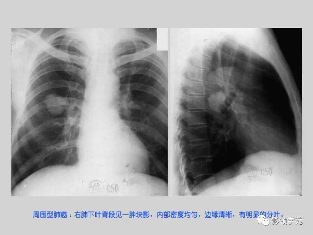 肺部常见疾病的影像诊断