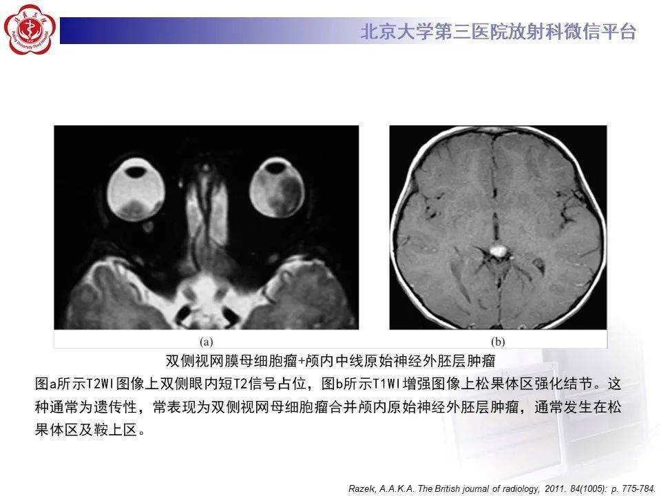 五官| 脉络膜黑色素瘤影像表现