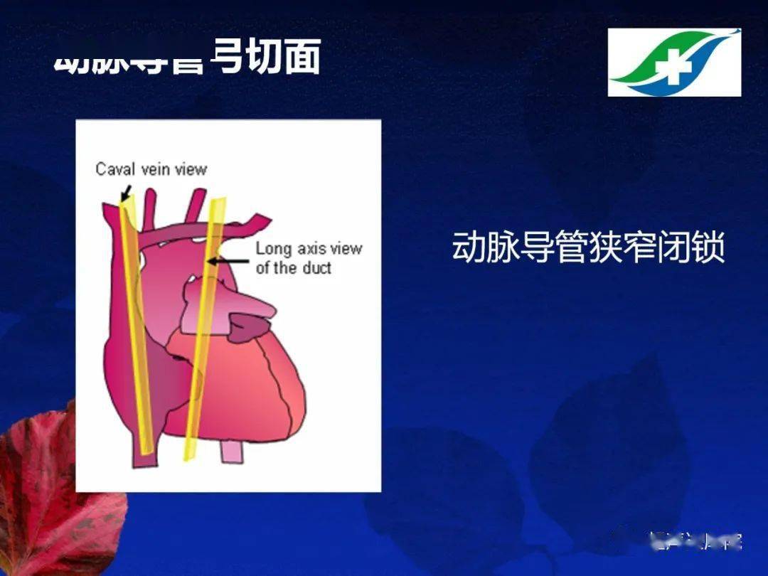 胎儿超声心动图基础及切面